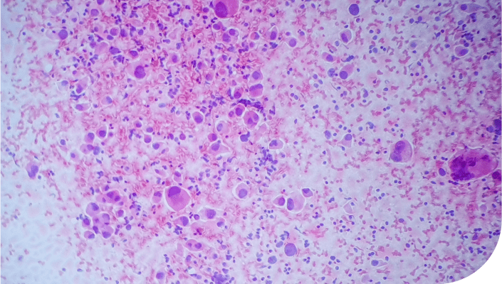 Qué es un tumor. Entende más sobre el cáncer.
