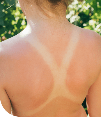 Factor de riesgo del cáncer. Radiación ultravioleta de los rayos solares. 