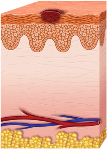 Etapas del melanoma (etapa 0)