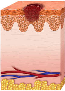 Etapas del melanoma (etapa 1)