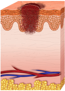 Etapas del melanoma (etapa 2)