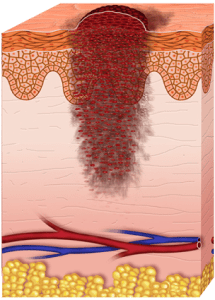 Etapas del melanoma (etapa 3)