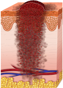 Etapas del melanoma (etapa 4)