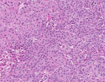 Tipos de cáncer de pulmón. Carcinoma de células escamosas (CCE)
