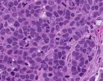 Tipos de cáncer de pulmón. Carcinoma (indiferenciado)
de células grandes