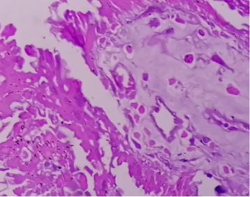 Tipos de cáncer de pulmón. Adenocarcinoma