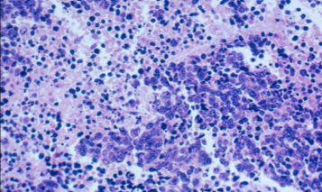 Tipos de cáncer de pulmón. Cáncer de pulmón de células pequeñas (CPCP) 
