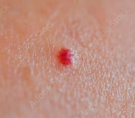 Melanoma Benigno 01