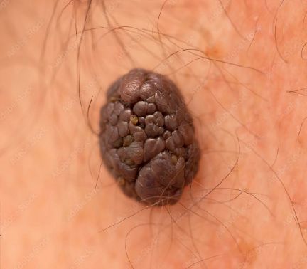 Melanoma Benigno 02