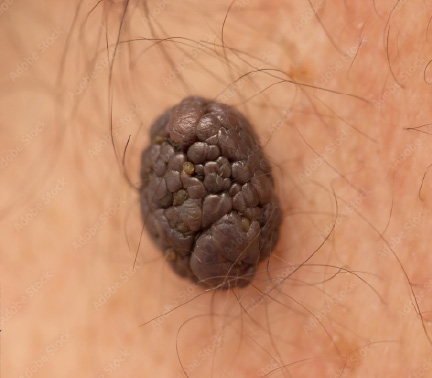 MelanomaBenigno02