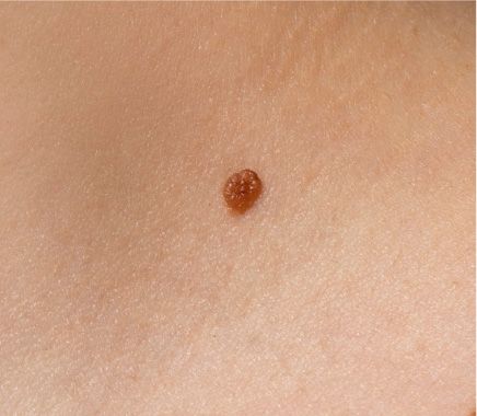 Melanoma Benigno 03