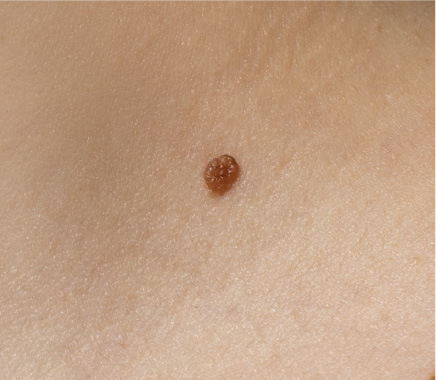 MelanomaBenigno03