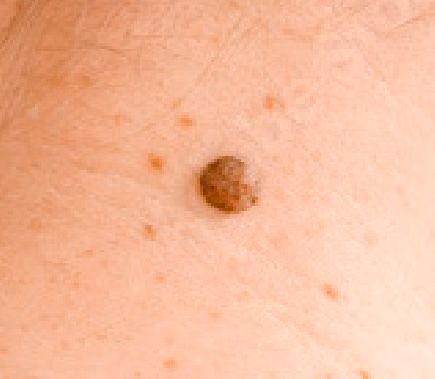 Melanoma Benigno 04