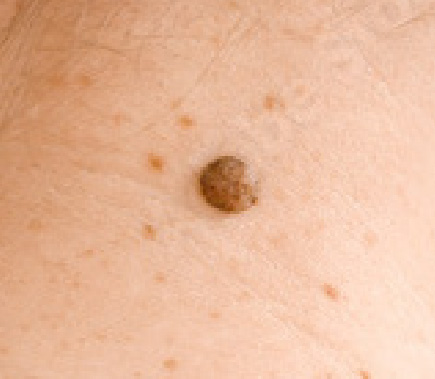 MelanomaBenigno04