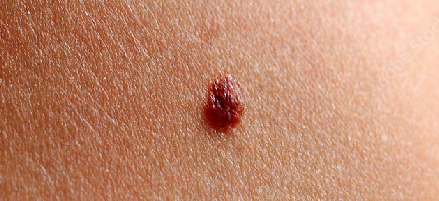 Melanoma Benigno 05