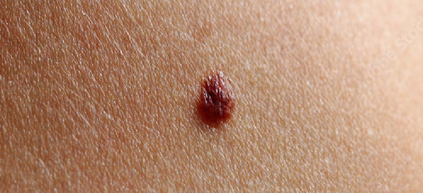 MelanomaBenigno05