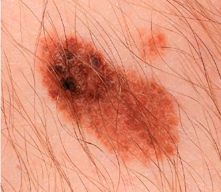 Melanoma Maligno 01