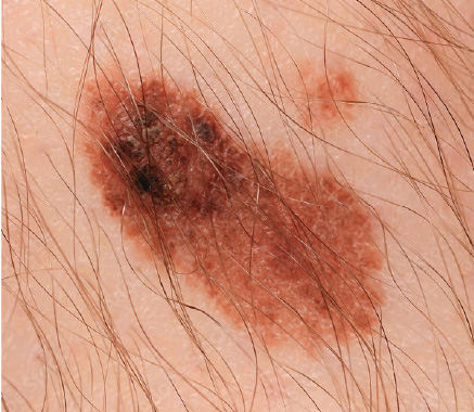 MelanomaMaligno01