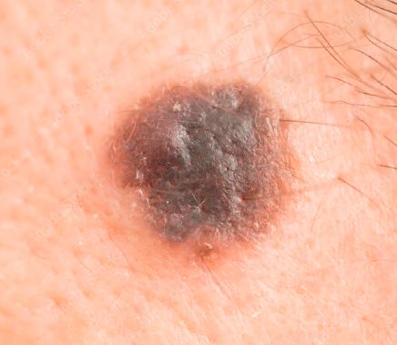 Melanoma Maligno 02