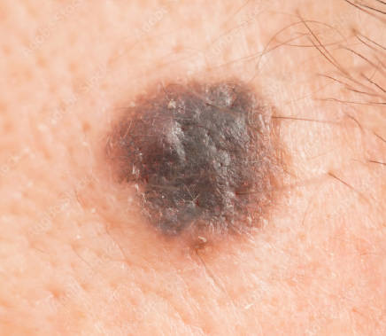 MelanomaMaligno02
