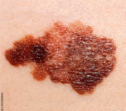 Melanoma Maligno 03