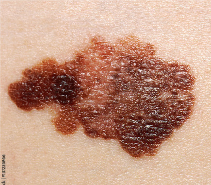 MelanomaMaligno03