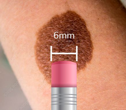 Melanoma Maligno 04