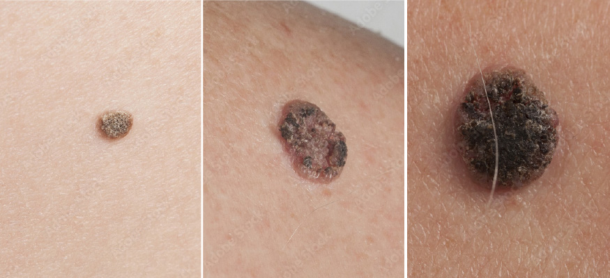 MelanomaMaligno05