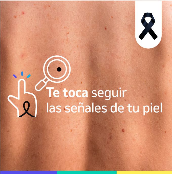 Melanoma. Aprende sobre las señales que te da tu piel para detectar el melanoma.