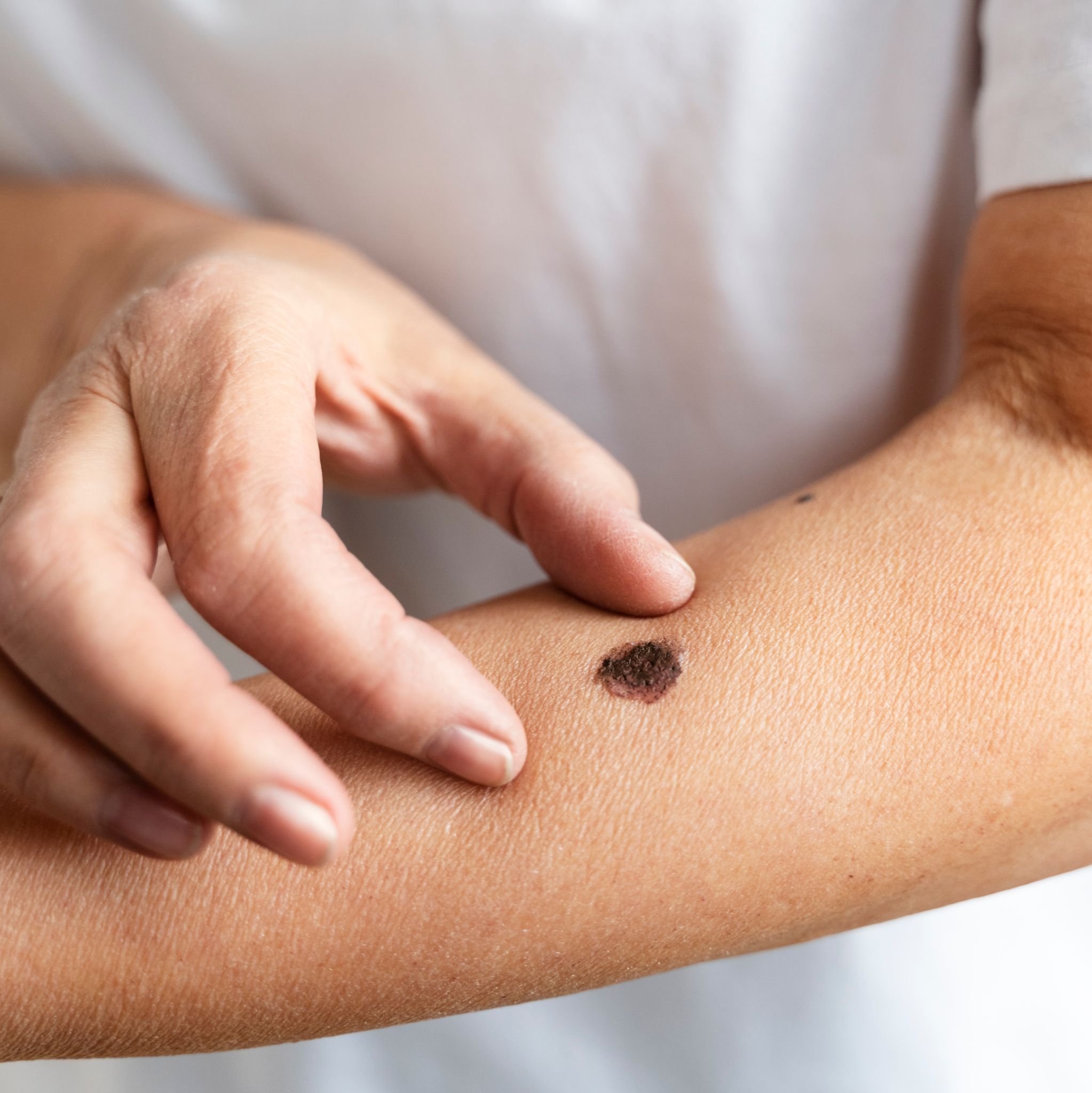 Detección de cáncer de piel - señales que te da tu piel.