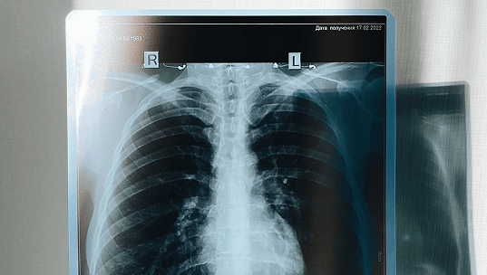 Radiografía para detectar el cáncer de pulmón.