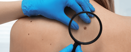 Autoexamen y revisión médica de la piel para detectar el cáncer de piel (melanoma)