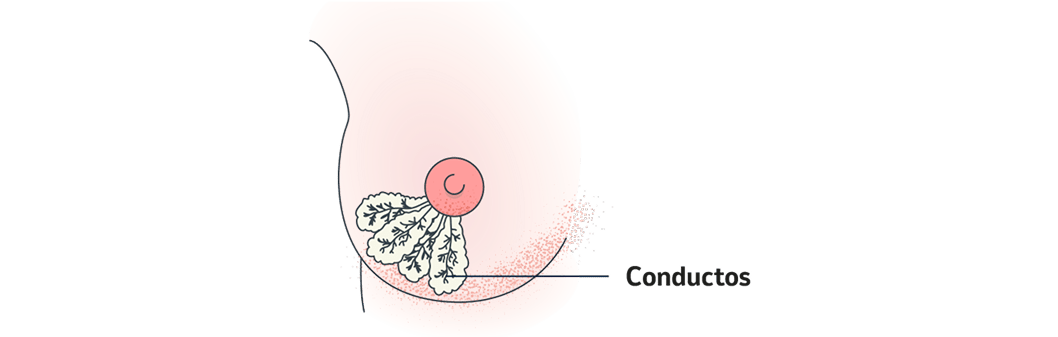 Tipos de cáncer de mama. Cáncer de mama in situ.