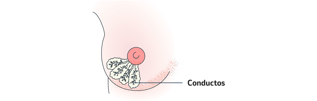 Tipos de cáncer de mama. Cáncer de mama in situ.