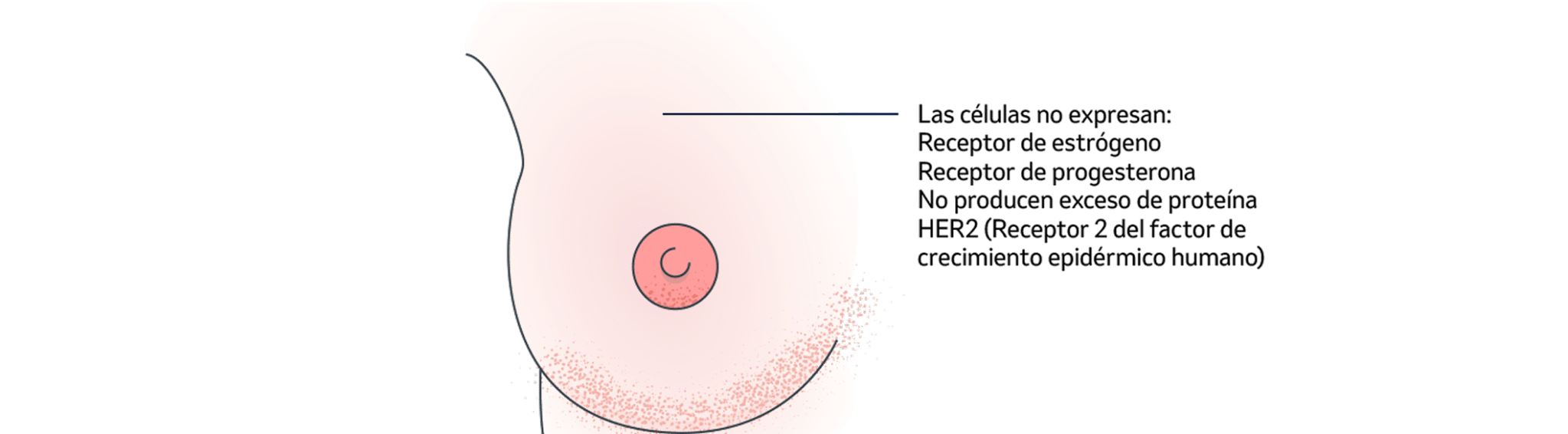 Tipos de cáncer de mama. Cáncer de mama invasivo con características especiales.