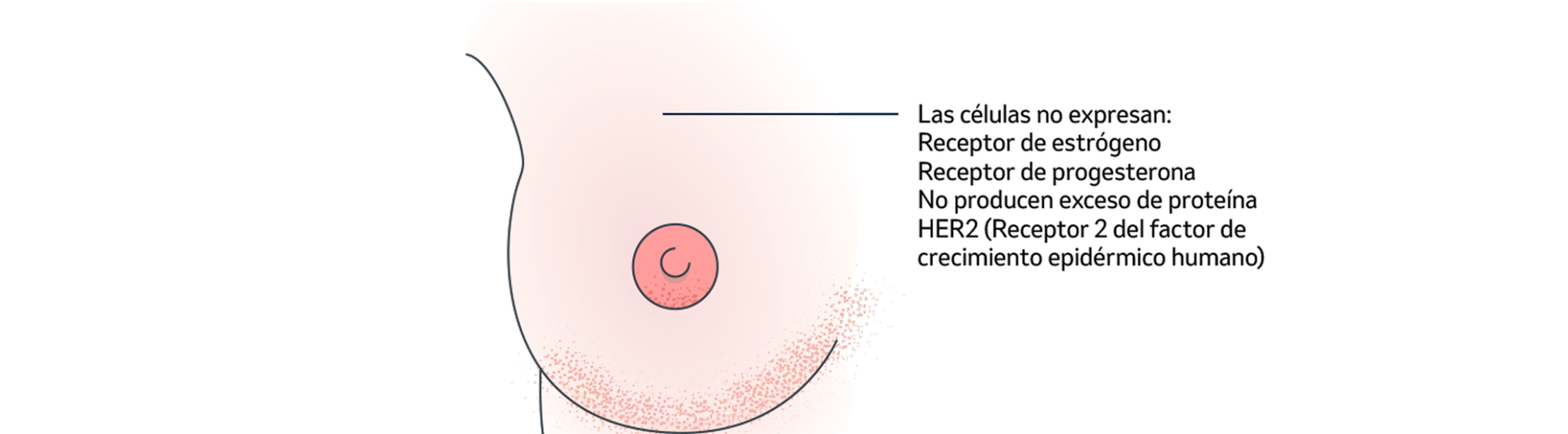 Tipos de cáncer de mama. Cáncer de mama invasivo con características especiales.