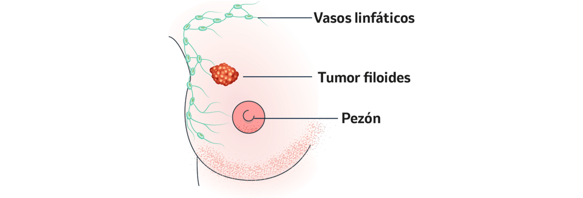 Tipos de cáncer de mama. Cáncer de mama menos común.